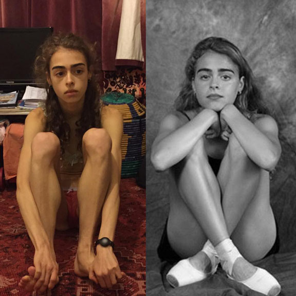Margherita Barbieri. Left, during battling with anorexia; right, after anorexia.